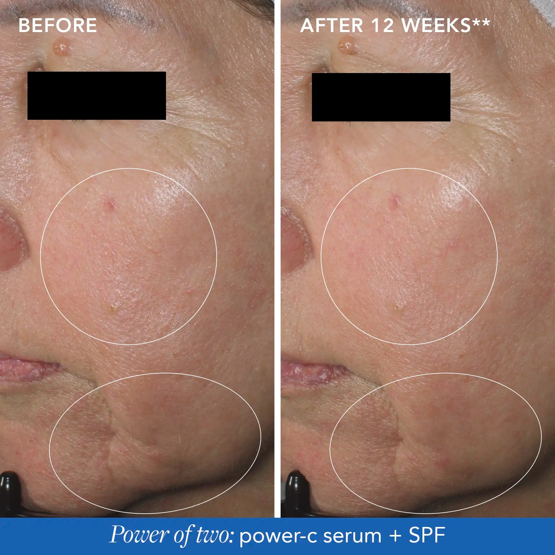 before & after results circled on a womans face