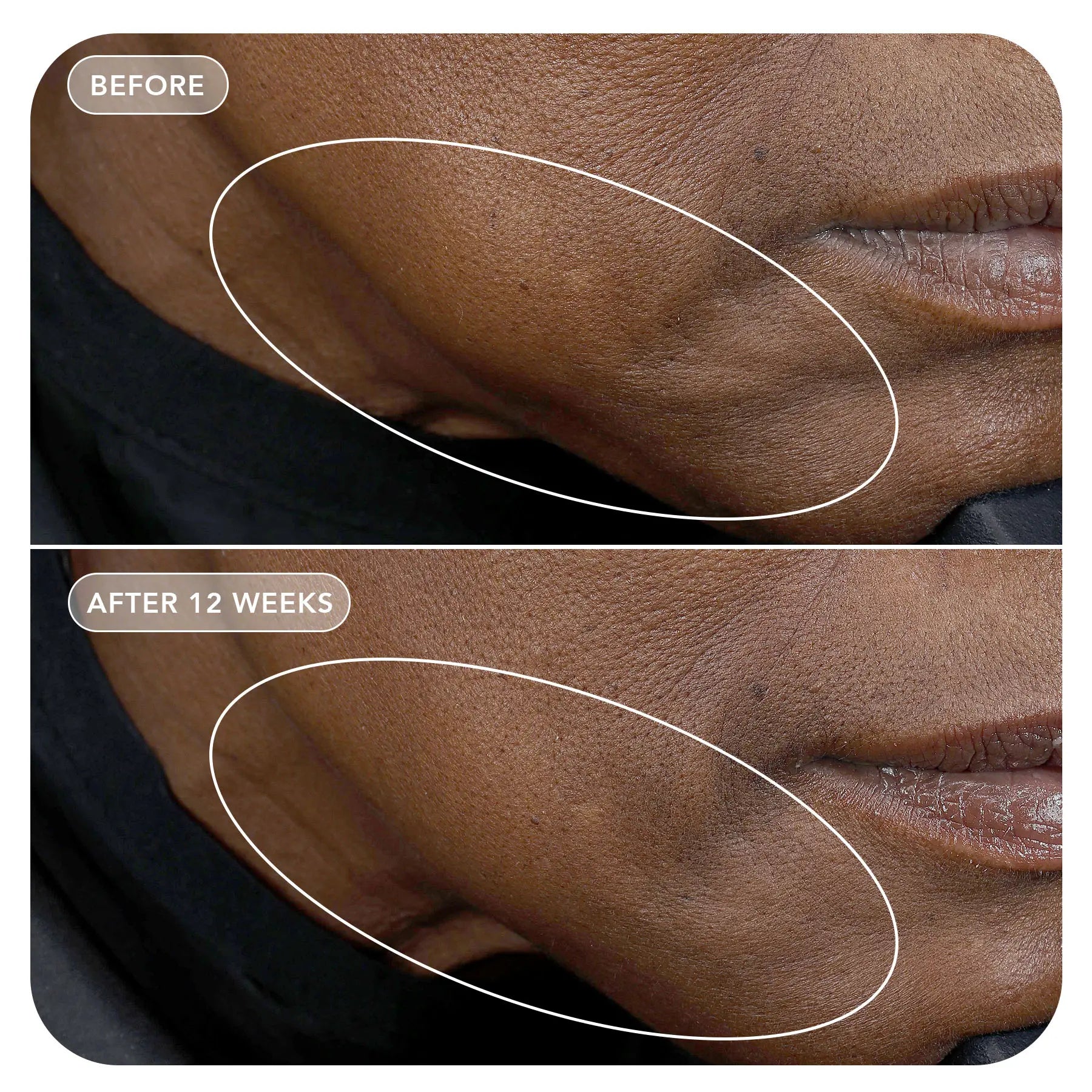 Before and after comparison of skin treatment on a person's neck.