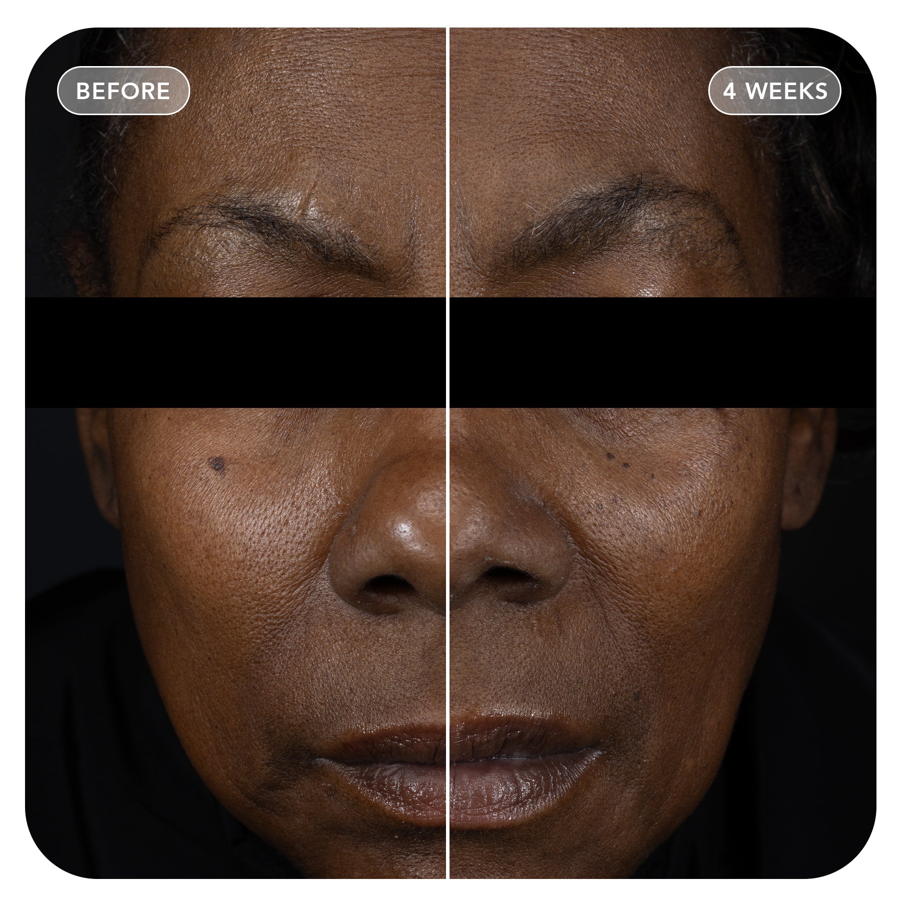 VOL.U.LIFT™ GLP-1 4D Skin Rebound Complex