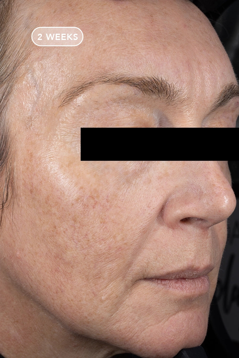 VOL.U.LIFT Before and After Skincare Pictures