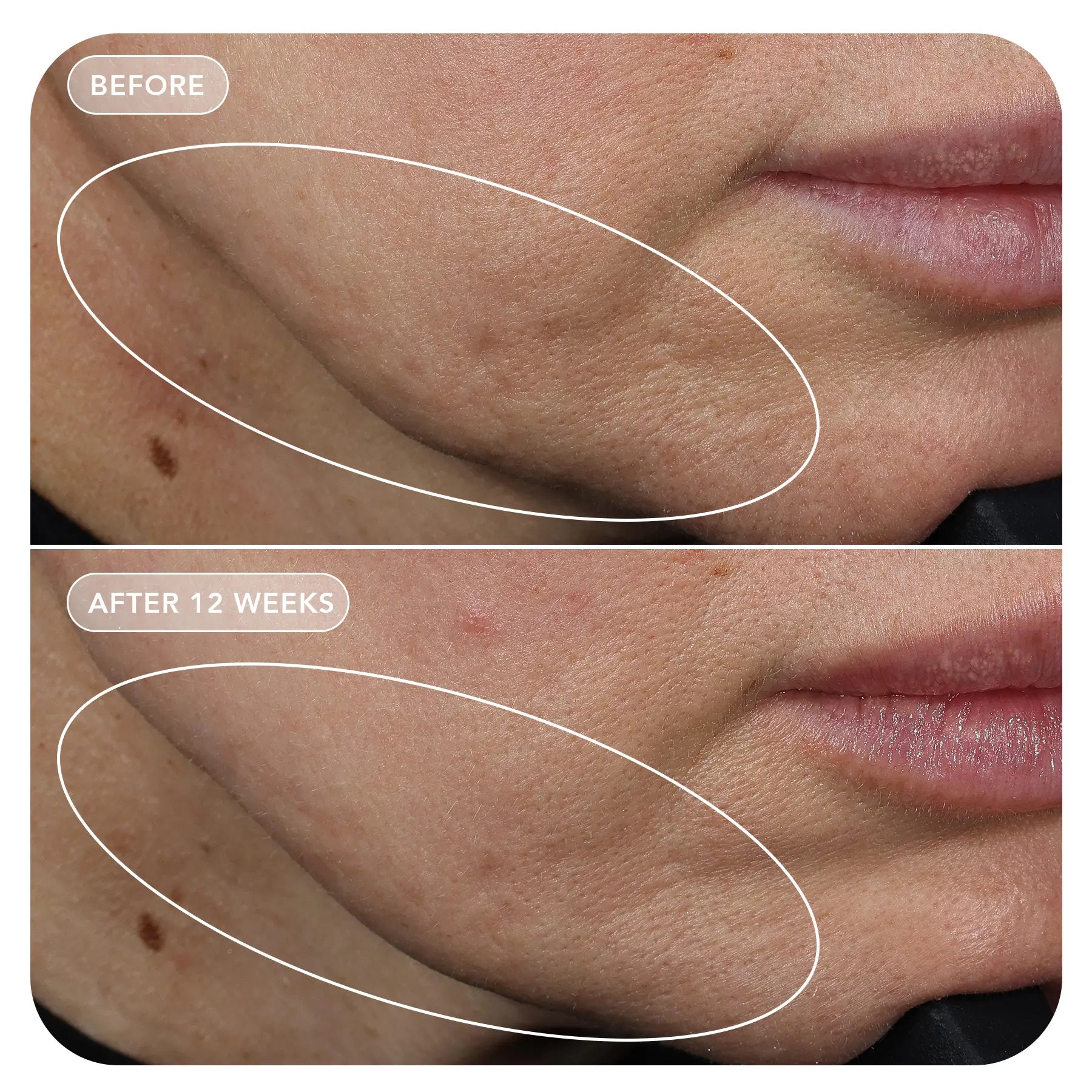 Before and after comparison of skin treatment on a person's cheek.
