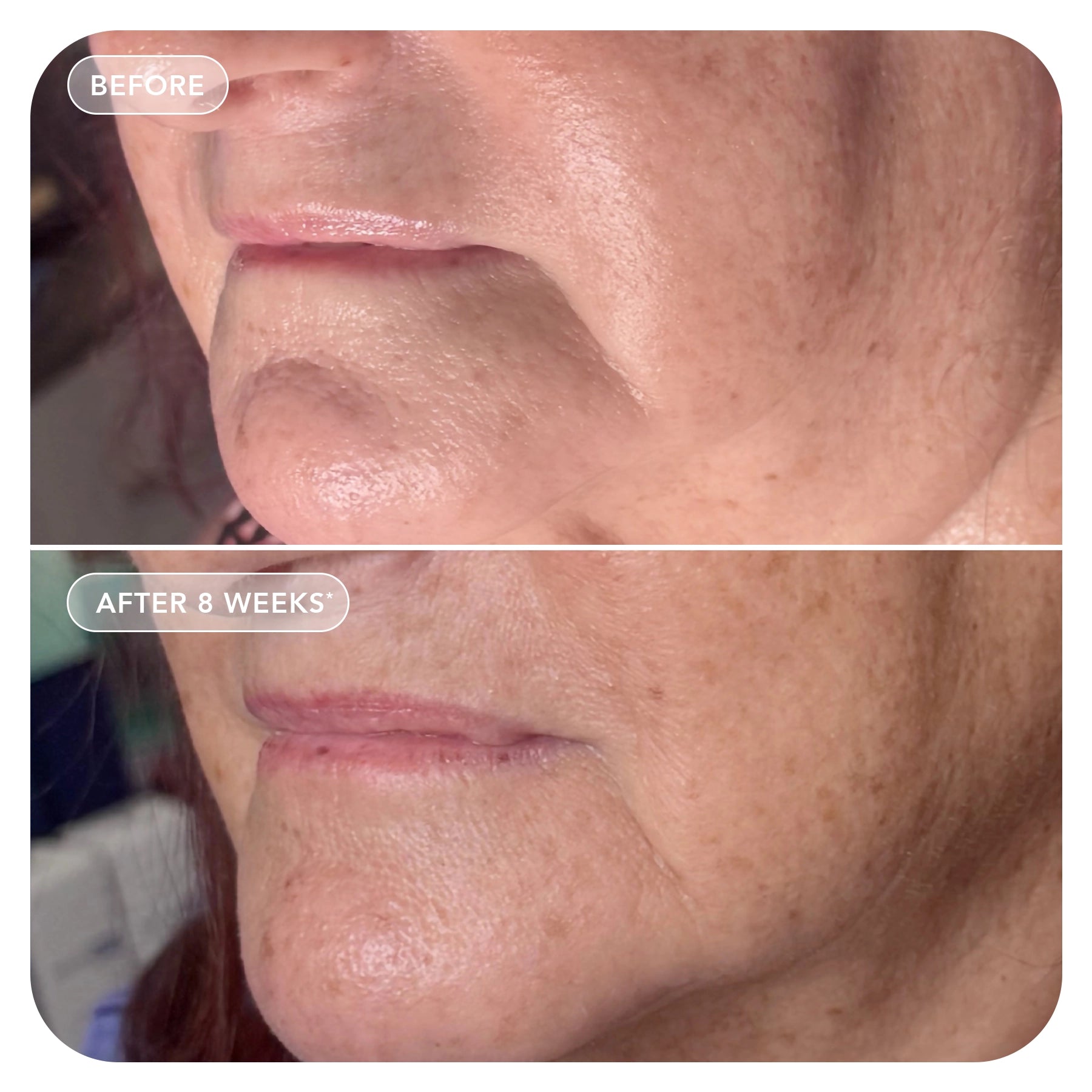 VOL.U.LIFT™ GLP-1 4D Skin Rebound Complex