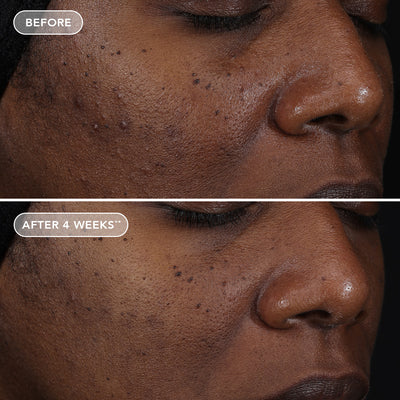Before and after comparison of a person's skin with visible improvement after 4 weeks.