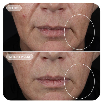 Before and after comparison of a person's face with visible skin texture and lines.