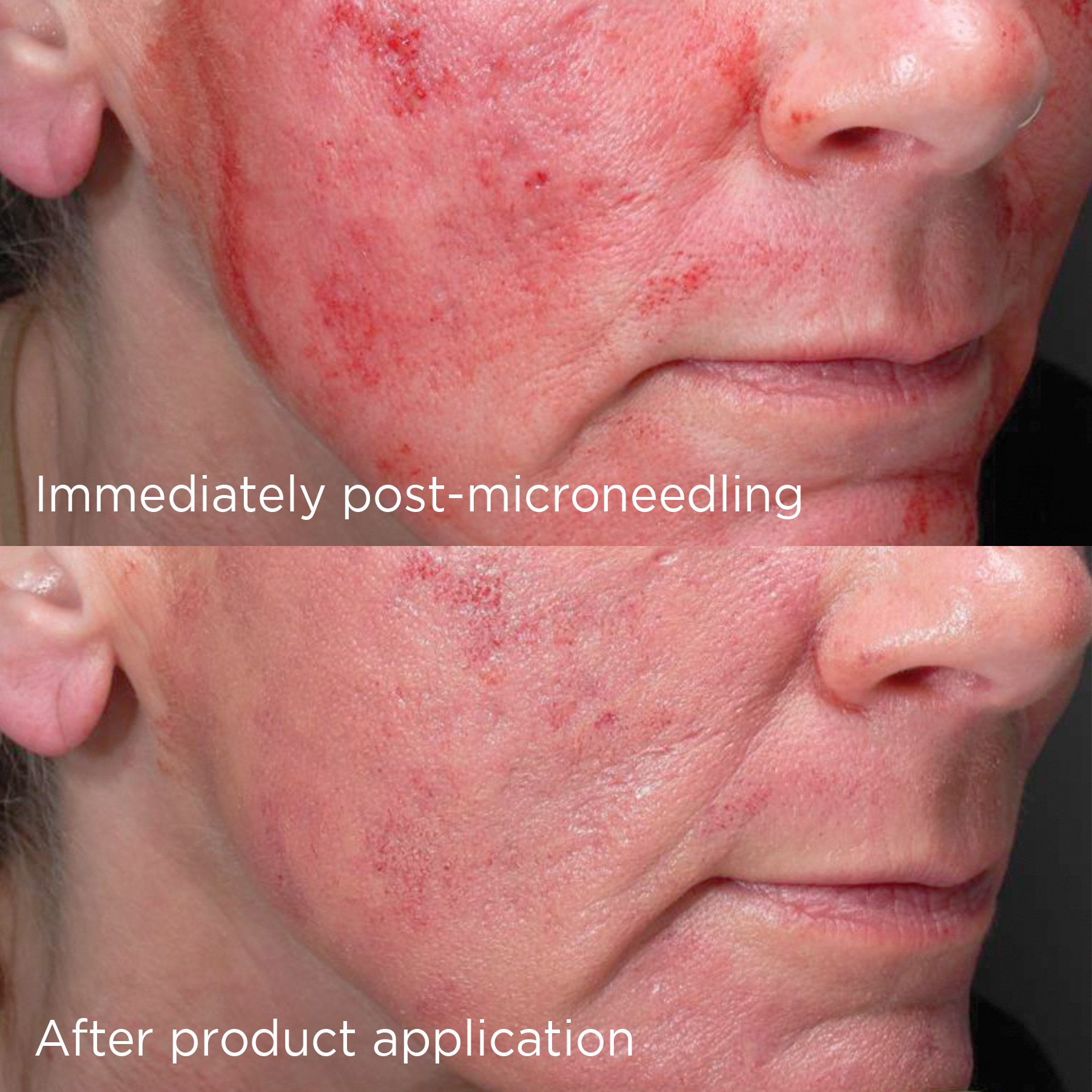 before and after application post microneedling