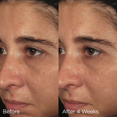 Before and after image of model showing results after 4 weeks