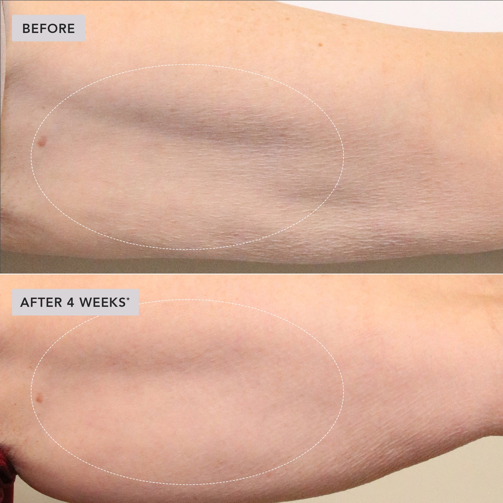Before-and-after comparison of skin texture on a forearm, with the top panel labeled BEFORE and the bottom panel labeled AFTER 4 WEEKS, showing a smoother, clearer skin result.