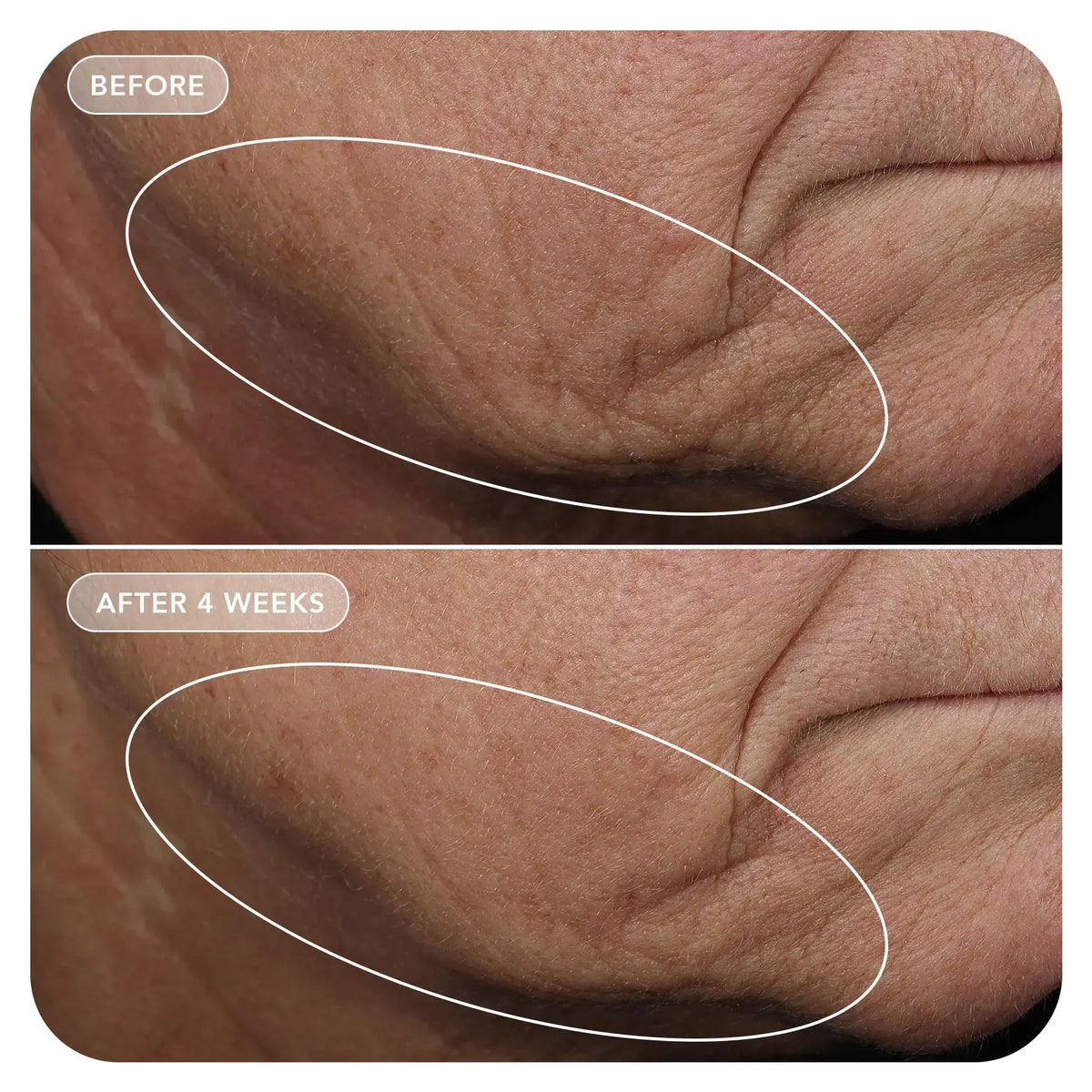 Before and after comparison of skin texture on a person's neck.