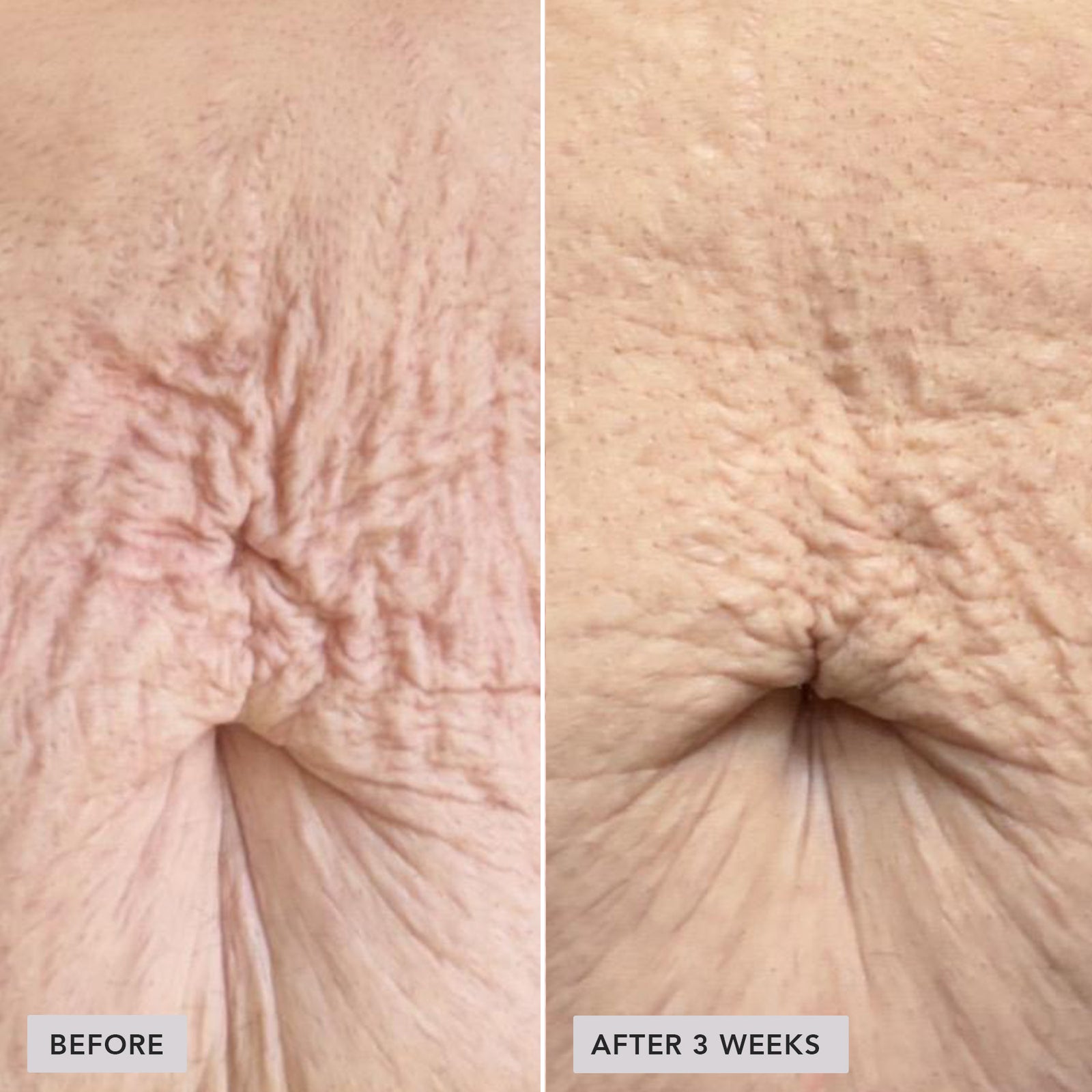 Before-and-after comparison of an abdominal hernia or umbilical hernia, showing skin tightening and reduction in wrinkling after 3 weeks.