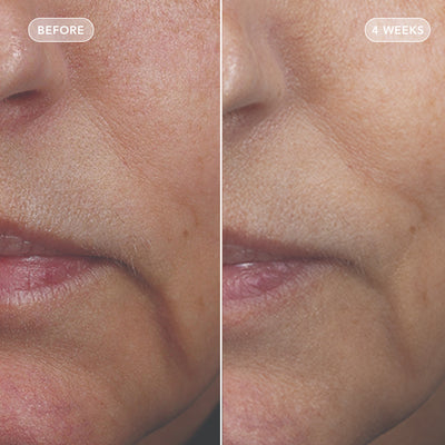 Close-up before-and-after comparison of a person's lower face, showing skin improvement over time with 'BEFORE' on the left and '4 WEEKS' on the right.